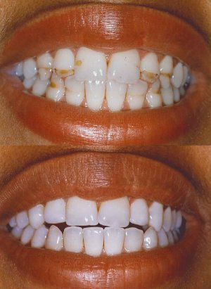 Enamel Defects