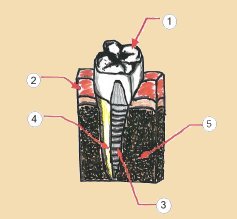 Dental Implant