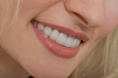 Veneers